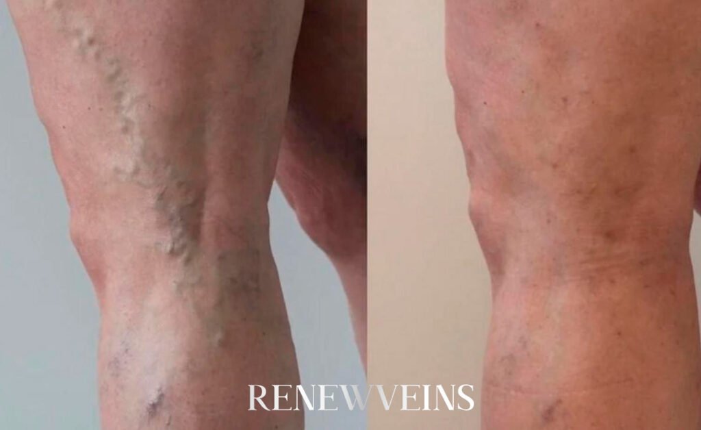 dep4_edit_renewveins.jpg